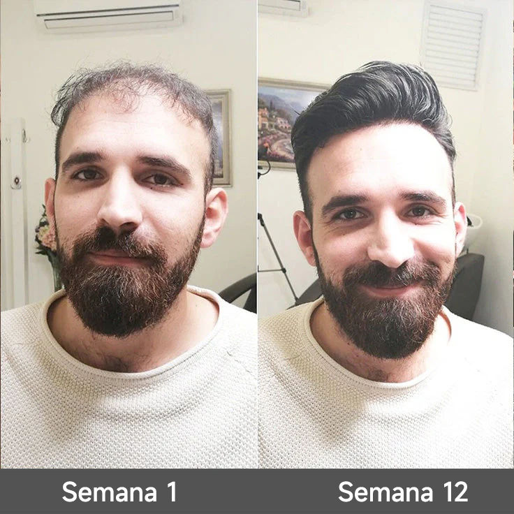🌿👨‍⚕️ Tienda oficial en EE. UU. 🇺🇸 | 🔥 Champú y acondicionador 2 en 1 PURELORA® de cebolla y romero con complejo activo 15X para el crecimiento capilar: para un cabello con apariencia más gruesa, abundante y fuerte.