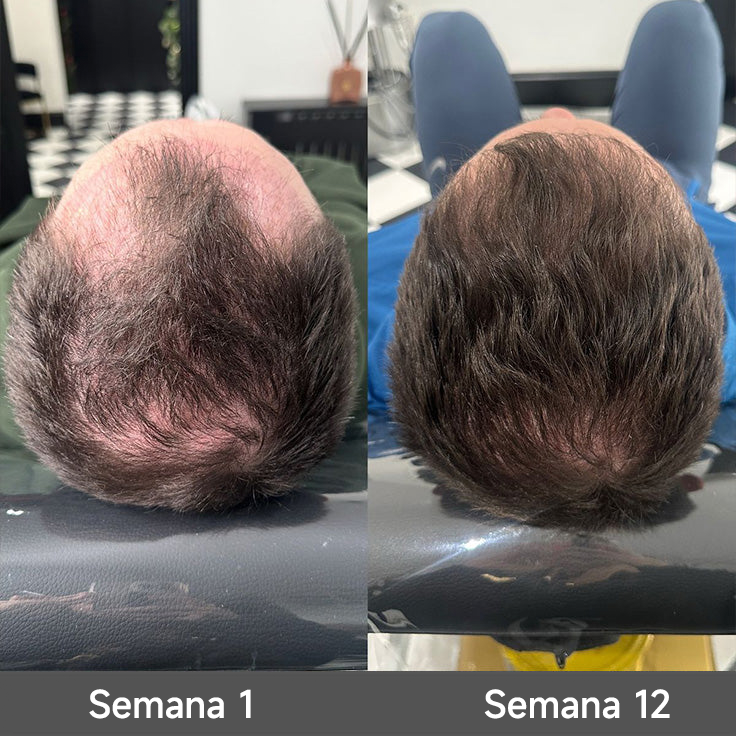 🌿👨‍⚕️ Tienda oficial en EE. UU. 🇺🇸 | 🔥 Champú y acondicionador 2 en 1 PURELORA® de cebolla y romero con complejo activo 15X para el crecimiento capilar: para un cabello con apariencia más gruesa, abundante y fuerte.