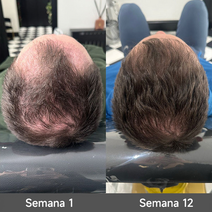 🌿👨‍⚕️ Tienda oficial en EE. UU. 🇺🇸 | 🔥 Champú y acondicionador 2 en 1 PURELORA® de cebolla y romero con complejo activo 15X para el crecimiento capilar: para un cabello con apariencia más gruesa, abundante y fuerte.