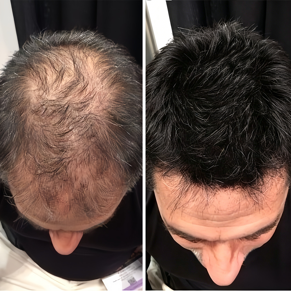 🌿👨‍⚕️ Tienda oficial en EE. UU. 🇺🇸 | 🔥 Champú y acondicionador 2 en 1 PURELORA® de cebolla y romero con complejo activo 15X para el crecimiento capilar: para un cabello con apariencia más gruesa, abundante y fuerte.