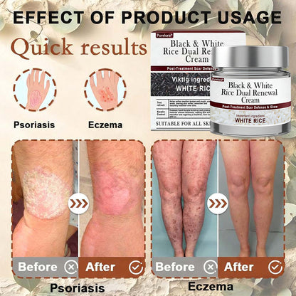 Online Pharmacy | New Arrival Purelora® Black & White Rice Dual Renewal Cream (For removing warts, skin growths & keratin buildup, followed by intensive barrier repair to fade dark spots and prevent scarring)